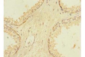 Immunohistochemistry of paraffin-embedded human prostate cancer using ABIN7175634 at dilution of 1:100 (VN1R5 antibody  (AA 185-269))