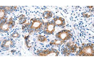 Immunohistochemistry of paraffin-embedded Human stomach cancer using Claudin 7 Polyclonal Antibody at dilution of 1:50 (Claudin 7 antibody)