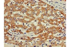 Immunohistochemistry of paraffin-embedded human liver cancer using ABIN7163167 at dilution of 1:100