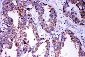 Anti- DISC1 antibody, IHC(P): Human Lung Cancer Tissue (DISC1 antibody  (Middle Region))