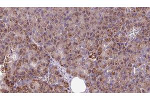 ABIN6273256 at 1/100 staining Human pancreas cancer tissue by IHC-P. (INSIG1 antibody  (Internal Region))