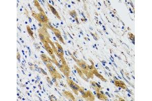 Immunohistochemistry of paraffin-embedded Human liver cancer using PLA2G2D Polyclonal Antibody at dilution of 1:100 (40x lens). (PLA2G2D antibody)