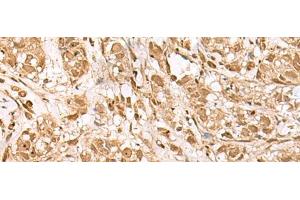Immunohistochemistry of paraffin-embedded Human breast cancer tissue using BAP1 Polyclonal Antibody at dilution of 1:35(x200) (BAP1 antibody)
