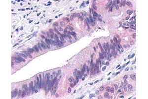 Anti-TNIK antibody IHC of human Pancreas, Carcinoma.