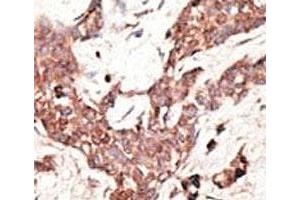IHC analysis of FFPE human breast carcinoma tissue stained with the SIRT3 antibody (SIRT3 antibody  (AA 250-279))