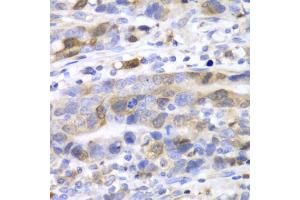 Immunohistochemistry of paraffin-embedded human gastric cancer using UBE2C antibody (ABIN5973207) at dilution of 1/100 (40x lens). (UBE2C antibody)