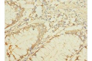Immunohistochemistry of paraffin-embedded human colon cancer using ABIN7145384 at dilution of 1:100 (B4GALNT2 antibody  (AA 301-566))