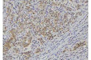 ABIN6278844 at 1/100 staining Human lung cancer tissue by IHC-P. (CRLF1 antibody)
