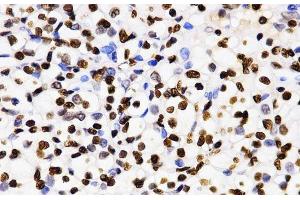Immunohistochemistry of paraffin-embedded Human kidney cancer using DiMethyl-Histone H3-K4 Polyclonal Antibody at dilution of 1:200 (40x lens). (Histone 3 antibody  (2meLys4))