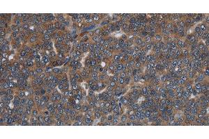 Immunohistochemistry of paraffin-embedded Human ovarian cancer tissue using LETMD1 Polyclonal Antibody at dilution 1:30 (LETMD1 antibody)