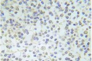 Immunohistochemistry (IHC) analyzes of p-Abl1 antibody in paraffin-embedded human breast carcinoma tissue. (ABL1 antibody  (pTyr204))