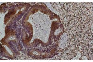 Immunohistochemistry of paraffin-embedded Human colon carcinoma tissue using Smad3 Monoclonal Antibody at dilution of 1:200. (SMAD3 antibody)