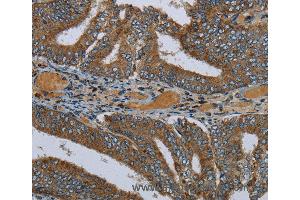 Immunohistochemistry of Human colon cancer using PCK2 Polyclonal Antibody at dilution of 1:60 (PEPCK antibody)