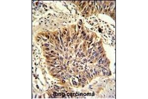 Formalin-fixed and paraffin-embedded human lung carcinoma with GOLPH3 Antibody (C-term), which was peroxidase-conjugated to the secondary antibody, followed by DAB staining. (GOLPH3 antibody  (C-Term))