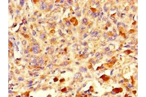 Immunohistochemistry of paraffin-embedded human melanoma using ABIN7162869 at dilution of 1:100 (Peptidyl-tRNA Hydrolase ICT1, Mitochondrial (AA 30-206) antibody)