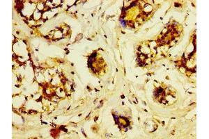 IHC image of ABIN7158571 diluted at 1:600 and staining in paraffin-embedded human breast cancer performed on a Leica BondTM system. (LRP2 antibody  (AA 202-332))