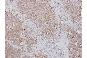 IHC-P Image Immunohistochemical analysis of paraffin-embedded AdCA xenograft, using RPL3, antibody at 1:100 dilution. (RPL3 antibody)