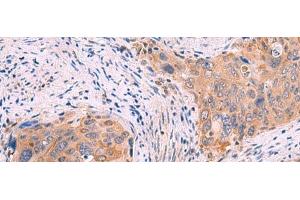 Immunohistochemistry of paraffin-embedded Human cervical cancer tissue using GSPT2 Polyclonal Antibody at dilution of 1:50(x200) (GSPT2 antibody)