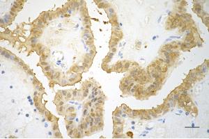Immunohistochemistry was performed on paraffin-embedded human papillary thyroid carcinoma using galectin 3 antibody (ABIN7798688), 1:200).