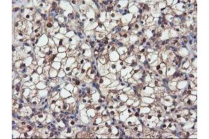 Immunohistochemical staining of paraffin-embedded Carcinoma of Human kidney tissue using anti-DPP9 mouse monoclonal antibody. (DPP9 antibody)