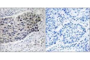 Immunohistochemistry analysis of paraffin-embedded human lung carcinoma tissue, using PC Antibody. (PC (AA 357-406) antibody)