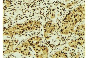 ABIN6276603 at 1/100 staining Human breast cancer tissue by IHC-P. (RASSF1 antibody  (Internal Region))
