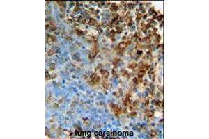 ITPA Antibody immunohistochemistry analysis in formalin fixed and paraffin embedded human lung carcinoma followed by peroxidase conjugation of the secondary antibody and DAB staining.