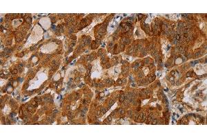 Immunohistochemistry of paraffin-embedded Human thyroid cancer tissue using MTUS1 Polyclonal Antibody at dilution 1:40 (MTUS1 antibody)