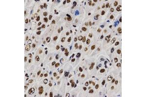 Immunohistochemistry of paraffin-embedded human liver cancer using PELP1 antibody (ABIN6292223) at dilution of 1:200 (40x lens). (PELP1 antibody)