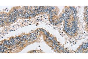 Immunohistochemistry of paraffin-embedded Human colon cancer using ARHGEF9 Polyclonal Antibody at dilution of 1:50 (Arhgef9 antibody)