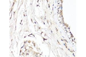 Immunohistochemistry of paraffin-embedded Human breast using CDK7 Polyclonal Antibody at dilution of 1:150 (40x lens). (CDK7 antibody)