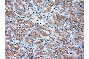 Immunohistochemical staining of paraffin-embedded Carcinoma of liver tissue using anti-SIGLEC9mouse monoclonal antibody. (SIGLEC9 antibody)