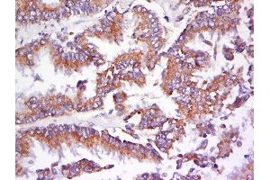 Formalin-fixed and paraffin embedded human lung carcinoma labeled with Anti-AMPK beta 1 Polyclonal Antibody, Unconjugated  at 1:200 followed by conjugation to the secondary antibody and DAB staining. (PRKAB1 antibody  (AA 2-100))