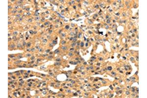 The image on the left is immunohistochemistry of paraffin-embedded Human breast cancer tissue using ABIN7131050(SH3KBP1 Antibody) at dilution 1/45, on the right is treated with fusion protein. (SH3KBP1 antibody)
