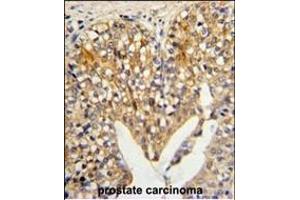 Formalin-fixed and paraffin-embedded human prostate carcinoma reacted with LUM Antibody (N-term), which was peroxidase-conjugated to the secondary antibody, followed by DAB staining. (LUM antibody  (N-Term))