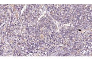 ABIN6273170 at 1/100 staining Human lymph cancer tissue by IHC-P. (STBD1 antibody  (N-Term))