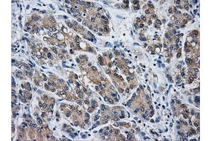 Immunohistochemical staining of paraffin-embedded Carcinoma of liver tissue using anti-AKR1A1mouse monoclonal antibody. (AKR1A1 antibody)