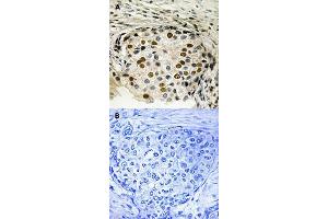 Immunohistochemical staining of human breast carcinoma tissue by OXSR1 (phospho T185) polyclonal antibody  without blocking peptide (A) or preincubated with blocking peptide (B) under 1:50-1:100 dilution. (OXSR1 antibody  (pThr185))