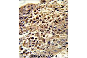 Formalin-fixed and paraffin-embedded human hepatocarcinoma reacted with VDAC1 Antibody , which was peroxidase-conjugated to the secondary antibody, followed by DAB staining. (VDAC1 antibody  (AA 95-124))