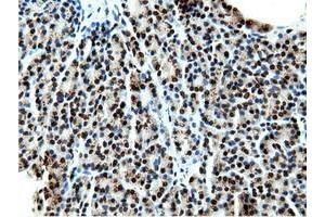 Immunohistochemical staining of paraffin-embedded Carcinoma of Human kidney tissue using anti-NT5DC1 mouse monoclonal antibody. (NT5DC1 antibody)