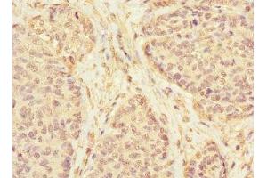 Immunohistochemistry of paraffin-embedded human ovarian cancer using ABIN7157271 at dilution of 1:100 (KLHL13 antibody  (AA 1-260))