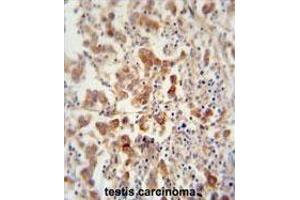 TEX13B antibody (C-term) immunohistochemistry analysis in formalin fixed and paraffin embedded human testis carcinoma followed by peroxidase conjugation of the secondary antibody and DAB staining.