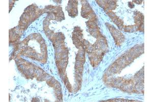Formalin-fixed, paraffin-embedded human Prostate Carcinoma stained with CD47 Mouse Monoclonal Antibody (IAP/3019).