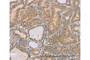 Immunohistochemistry of Human breast cancer using PTPN4 Polyclonal Antibody at dilution of 1:40