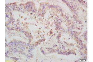 Formalin-fixed and paraffin embedded human colon carcinoma labeled with Anti-Phospho-TBK1/NAK (Ser172) Polyclonal Antibody, Unconjugated (ABIN746363) at 1:200 followed by conjugation to the secondary antibody and DAB staining