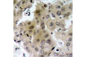 Immunohistochemistry of paraffin-embedded human breast carcinoma using Phospho-KDR-Y1175 antibody (ABIN2988109).