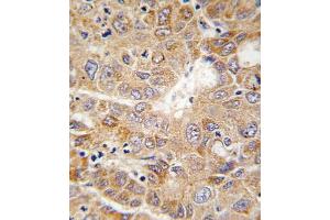 Formalin-fixed and paraffin-embedded human hepatocarcinoma tissue reacted with PGK1 antibody (Center), which was peroxidase-conjugated to the secondary antibody, followed by DAB staining.