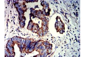 Immunohistochemical analysis of paraffin-embedded rectum cancer tissues using PAX8 mouse mAb with DAB staining. (PAX8 antibody  (AA 60-261))
