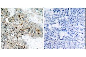 Immunohistochemical analysis of paraffin-embedded human breast carcinoma tissue using Integrin β3 (phospho-Tyr773) antibody (E011060). (Integrin beta 3 antibody  (pTyr773))