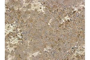 ABIN6257930 and ABIN6274821 at 1/100 staining human melanoma by IHC-P. (AGXT2L2 antibody  (C-Term))